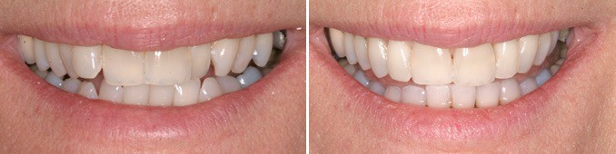 Before and After Six Month Braces