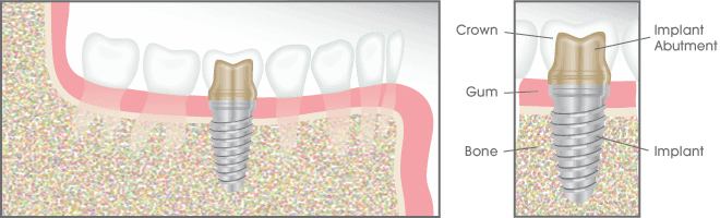 Dental Implants Illustration - Farmington Village Dental