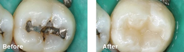 Dental Fillings Before and After - Farmington Village Dental CT