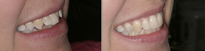 Powerprox Accelerated Braces - Before and After