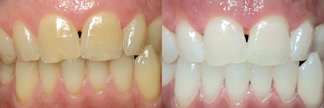 Professional Teeth Whitening in Farmington CT
