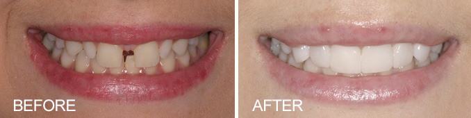 Smile Makeover with Six Month Braces and Veneers - Farmington Village Dental