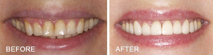 Veneers - Before and After - Farmington Village Dental