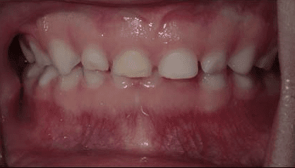 Child Bite dental image