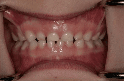 Child Bite - dental infection