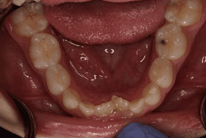 Child Teeth June 2015