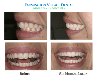 Short Term Orthodontics Farmington