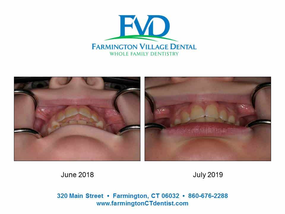 Tooth overbite-1-yr - Farmington