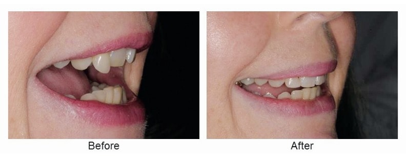 Before - After Christine dental Image