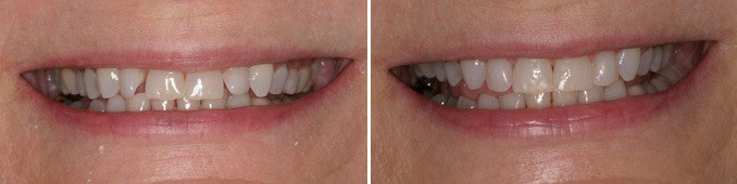 Farmington CT Clear Braces