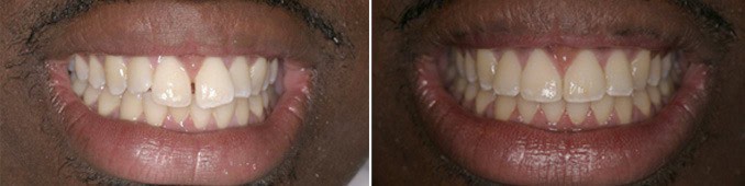 Clear Braces in Farmington CT