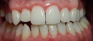 Gum disease Farmington CT
