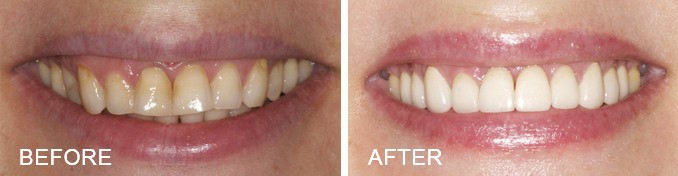 Veneers Farmington