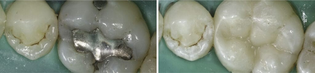 Tooth Fillings Farmington