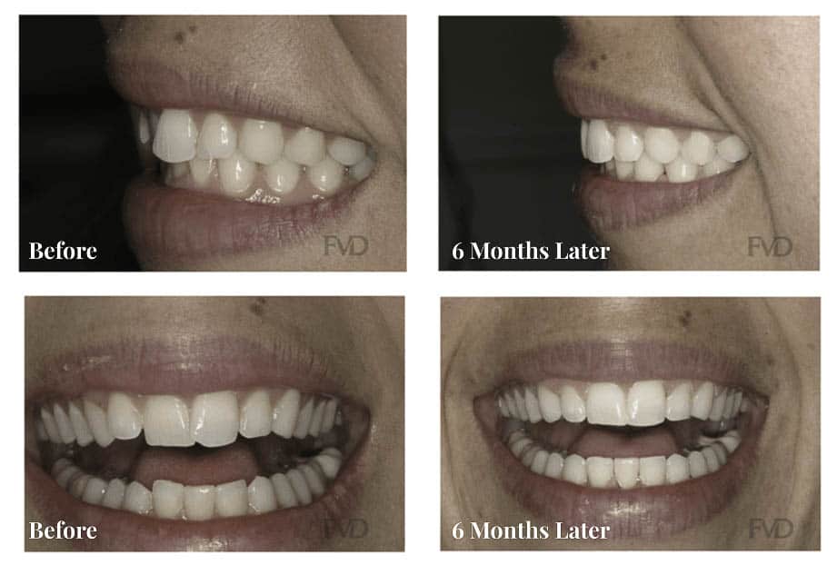 Orthodontics Farmington CT