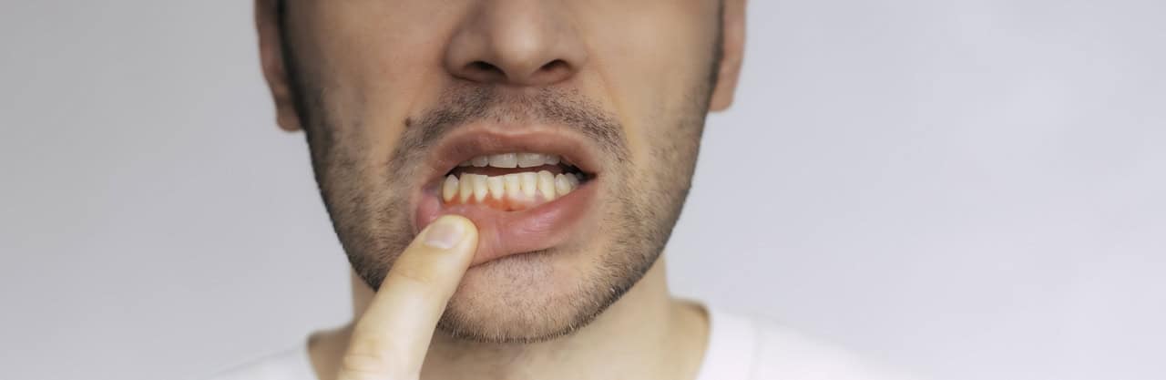 Gum Disease Treatment